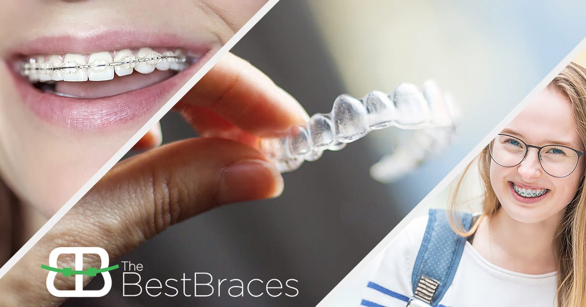 Bringing the Best Choices in Braces to You! Bringing the Best Choices in Braces to You!