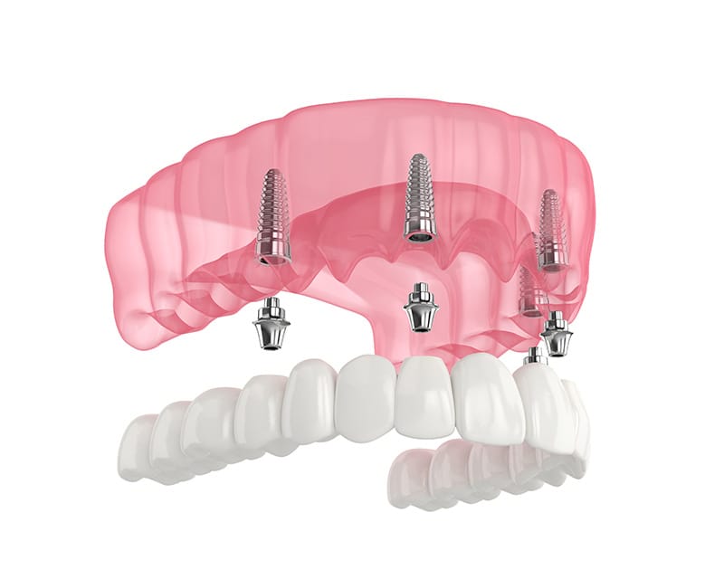 All-on-4 dental implant treatment with Dr. Jutkowitz in Roslyn Heights