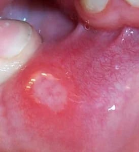 Oral Herpes