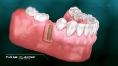 Screw-Retained Implant 002