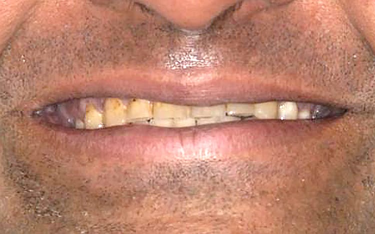 26. Patient VB (all 28 teeth) _ 14 upper porcelain crowns and 14 lower porcelain crowns Before
