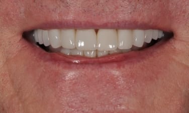 Sparkling Smiles Fayetteville After image