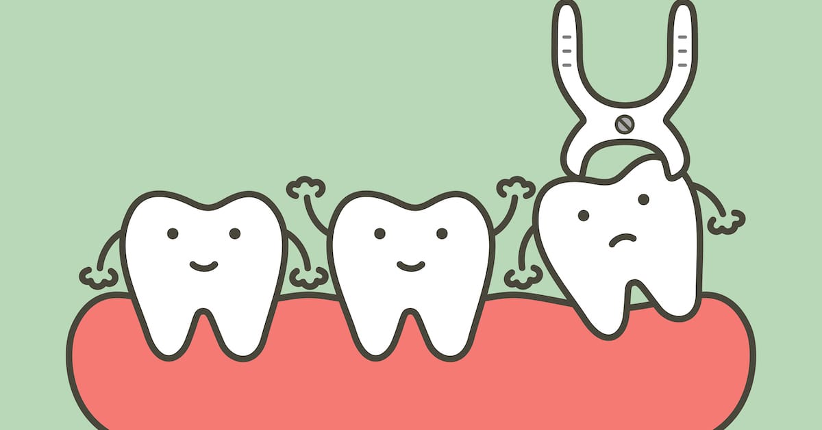 What to Expect With a Tooth Extraction