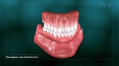 Locator Retained Overdenture 002