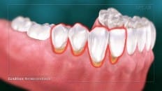 Non-Carious Cervical Lesions 002