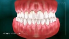 Understanding Tooth Wear 001