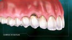 Peri-Implant Mucositis 004