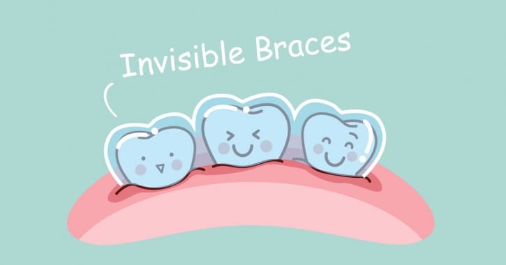 Eight Answers about Living with Invisalign