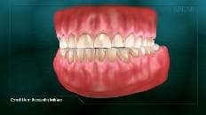Understanding Tooth Wear 002
