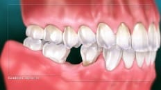 Single Tooth Loss 004