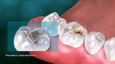 Amalgam Filling (Posterior) 002