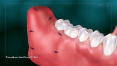 Surgical Extraction (3rd Molar) 004