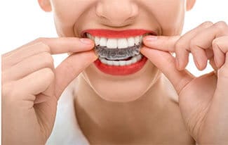 How to Clean Your Invisalign Aligners