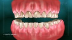 Dental Erosion 005