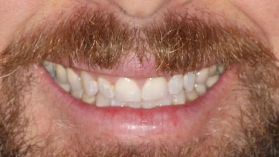 Anastasia Smile 13 before image