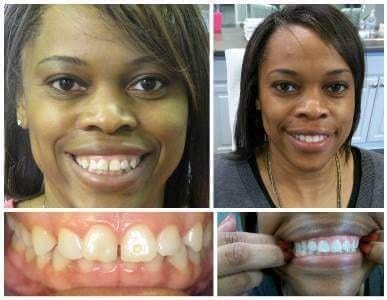 Before and after