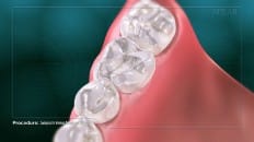 Composite Versus Amalgam Filling 006