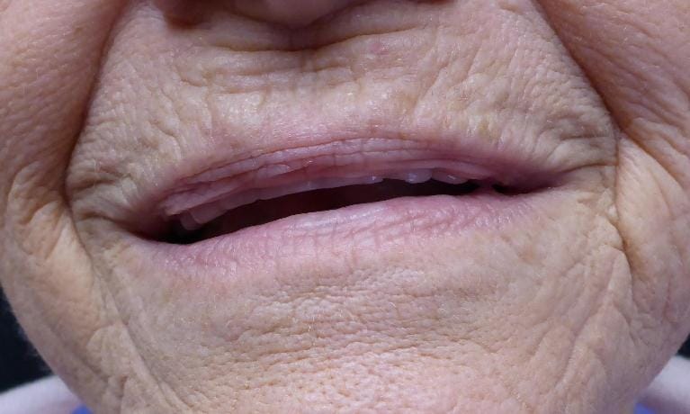 Grapevine Before Smile Transformation 2