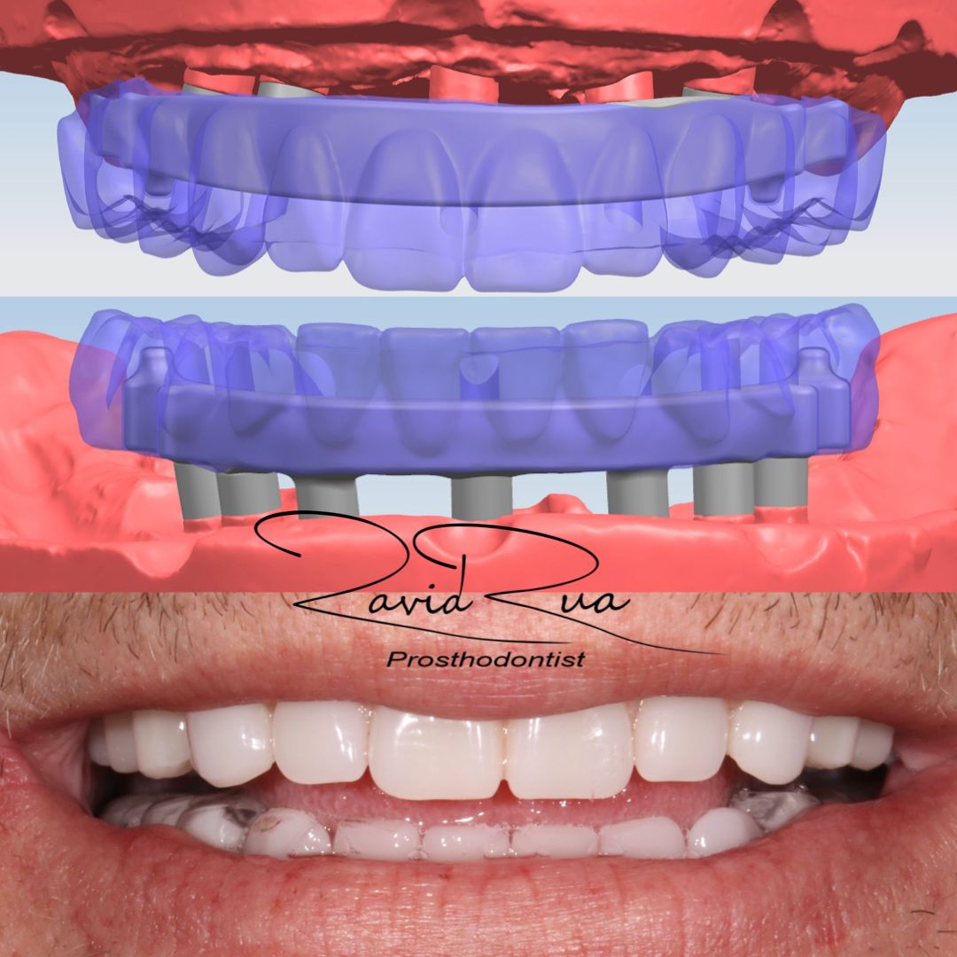 TC Cape Coral Case 5.1 All on 6-7 implant hybrids