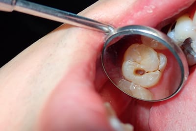 Tooth decay image Tooth decay image