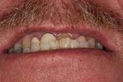 Restoration before