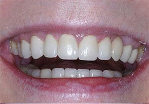 ballston smile gallery case-10-after