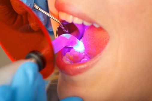 TEETH BONDING