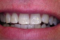 Zoom Whitening after