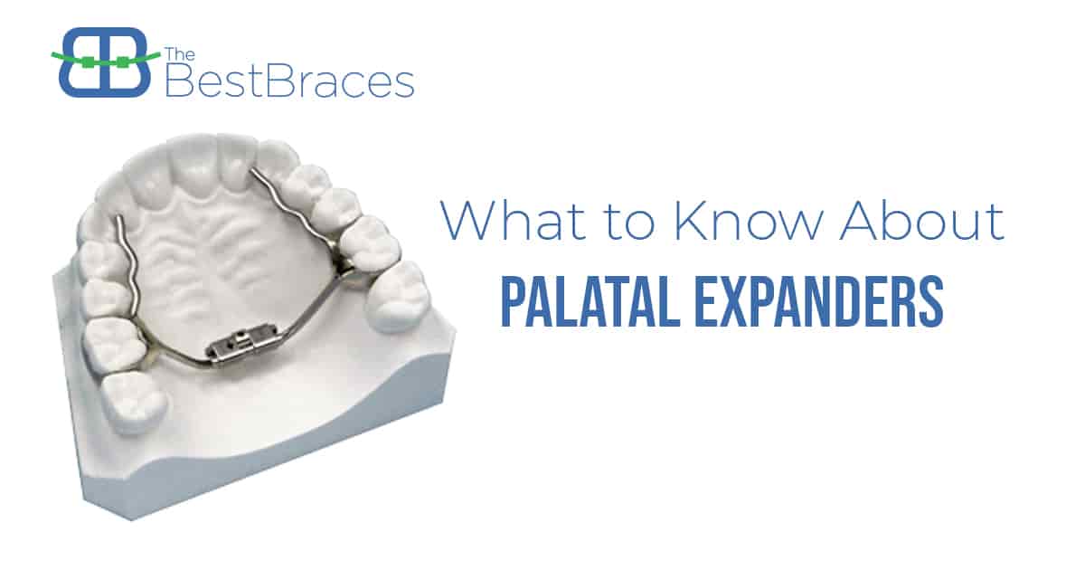 What to Know About Palatal Expanders