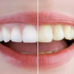teeth whitening