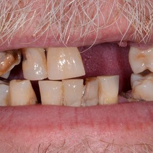 The Foehr Group Dentures - Before