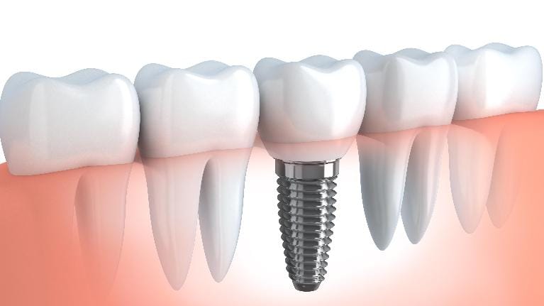 Tooth Replacement Tooth Replacement