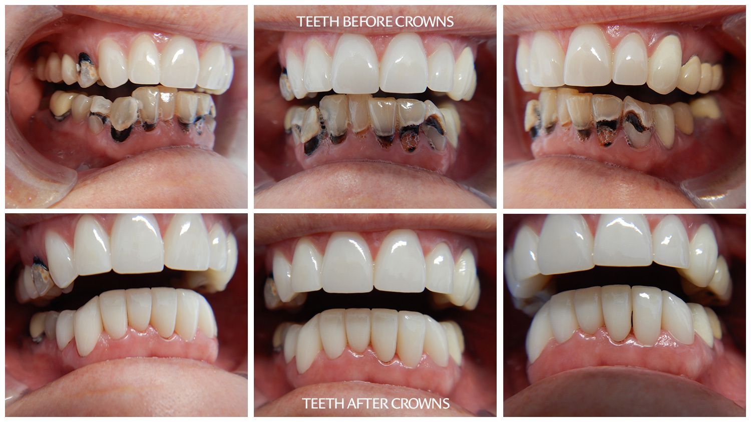 Teeth before and after crowns