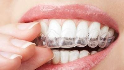 Why You Should Consider Invisalign Why You Should Consider Invisalign
