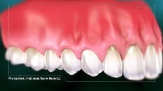 Single Implant (Anterior - Healing Cap) 006