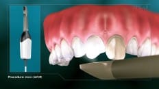 Veneers image 002