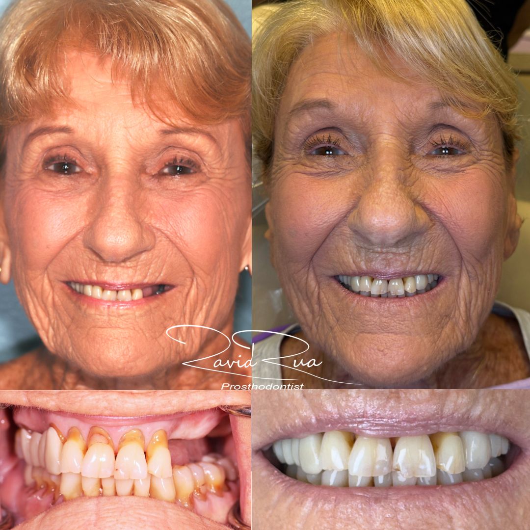 TC Cape Coral Case 14 Top implant bridge