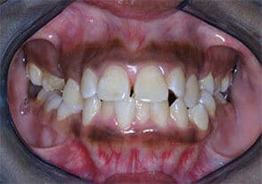 ballston smile gallery case-2-before
