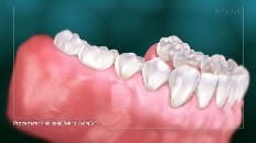 Single Implant (Posterior- Healing Cap) 007