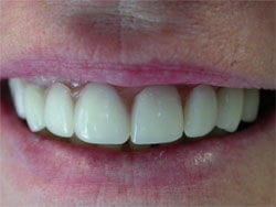 Partial Dentures after