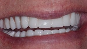 Dental Implants After