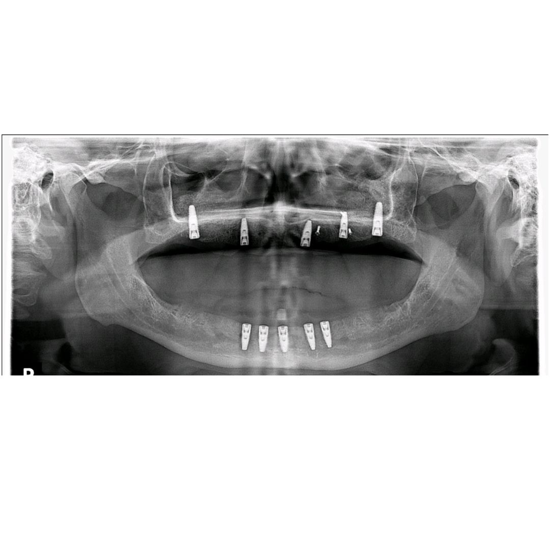 TC Cape Coral Case 18.1 All on 5 implant hybrids