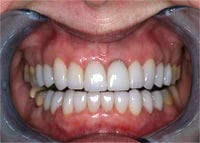 Veneers after