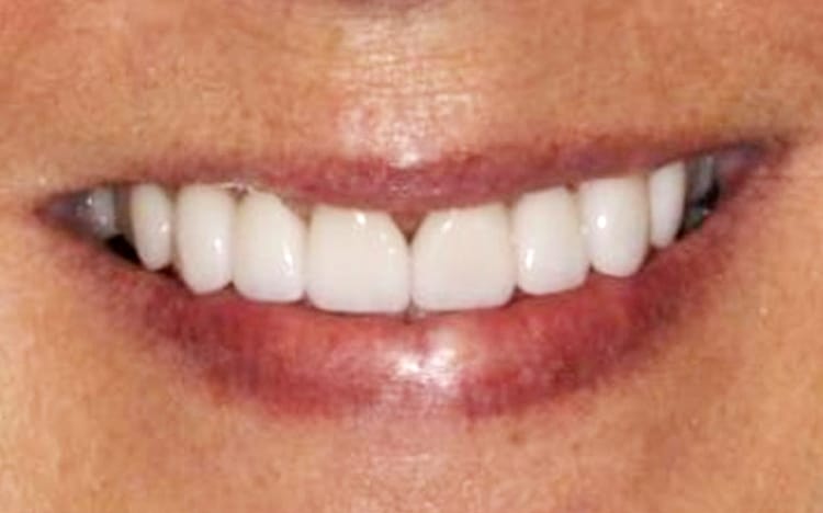 12. Patient LB (8 teeth)_ Mix of porcelain veneers and crowns on upper 8 teeth after trauma After