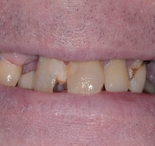 Dental Implants Before