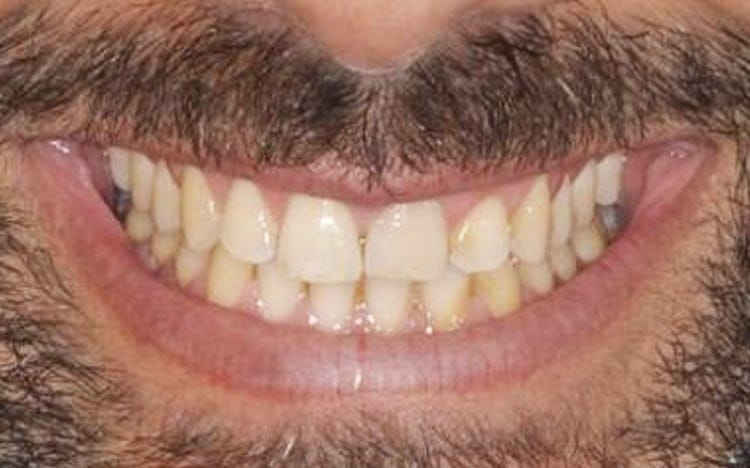 5. Patient KT_ One front tooth porcelain veneer and an adjacent implant with custom tissue shaping and porcelain implant crown Before