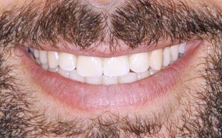 5. Patient KT_ One front tooth porcelain veneer and an adjacent implant with custom tissue shaping and porcelain implant crown After