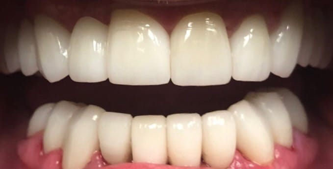 Bright Smiles Marble Falls Case 2 after