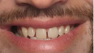 Veneers before