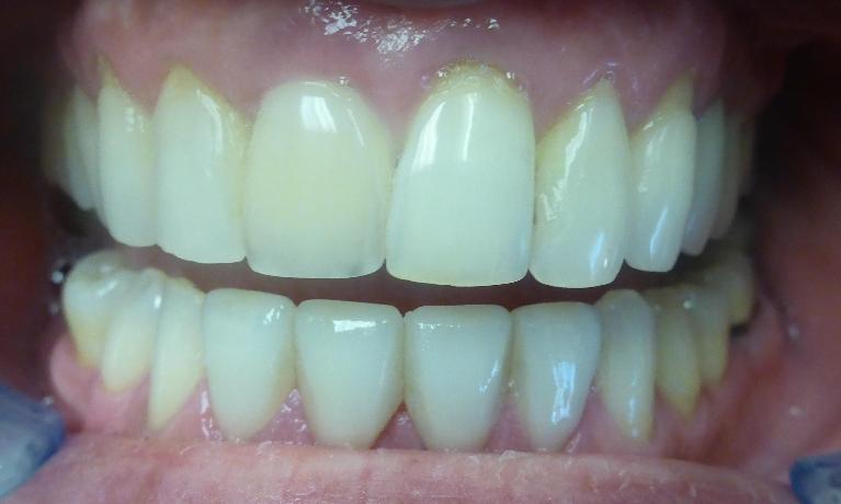Grapevine After Veneers Bottom